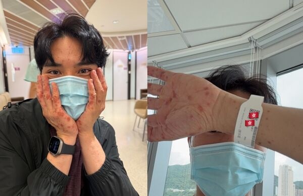 陈浚霆游法国健行突长红疹! 急返香港转介住院配图