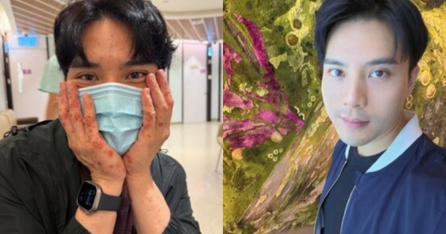 陈浚霆游法国健行突长红疹! 急返香港转介住院配图